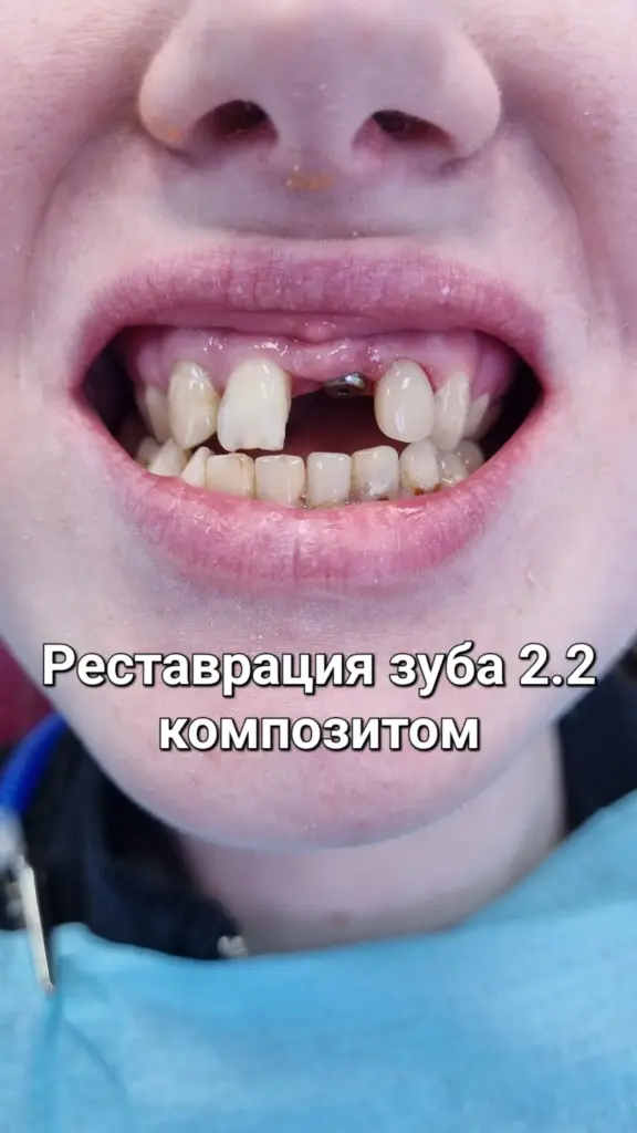 Улыбка с имплантом и художественной реставрацией