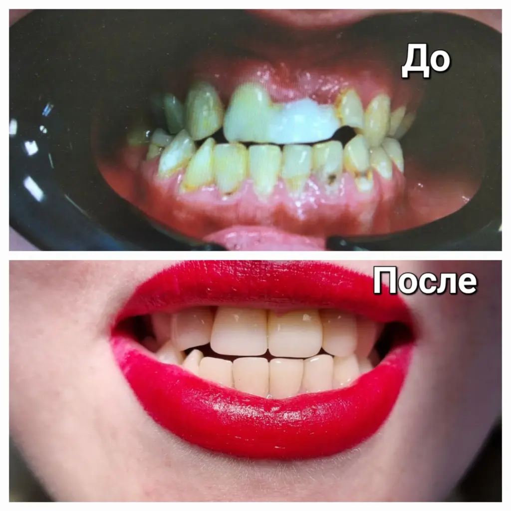 Улыбка с имплантом и художественной реставрацией