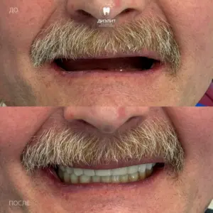 До: Имплантация верхней и нижней челюсти