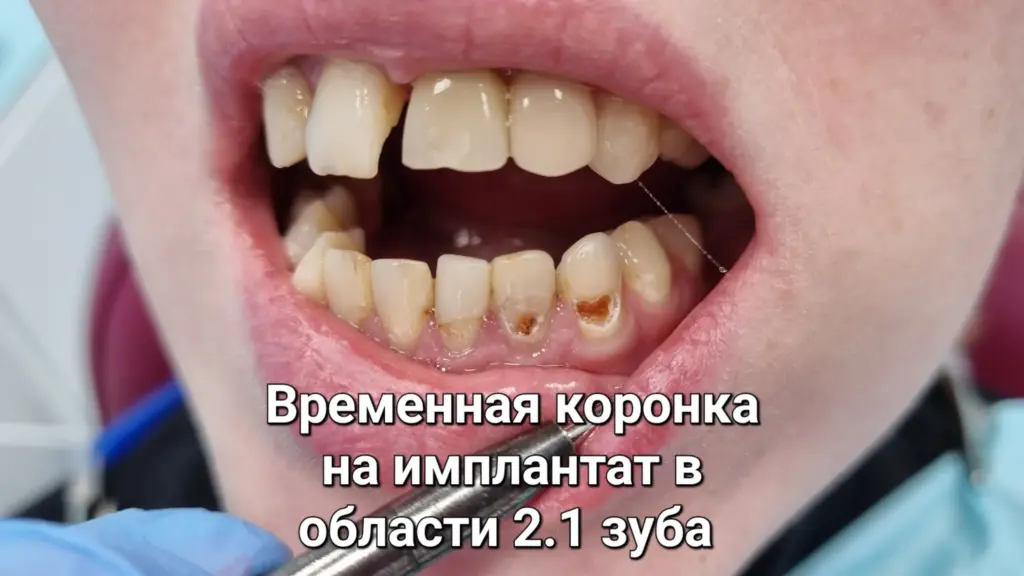 Улыбка с имплантом и художественной реставрацией