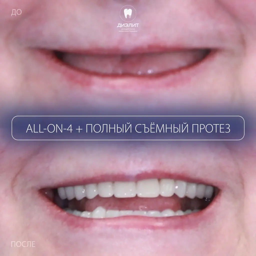 Полное восстановление зубов на имплантах All-on-4