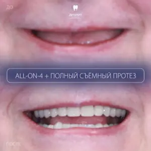 До: Полное восстановление зубов на имплантах All-on-4