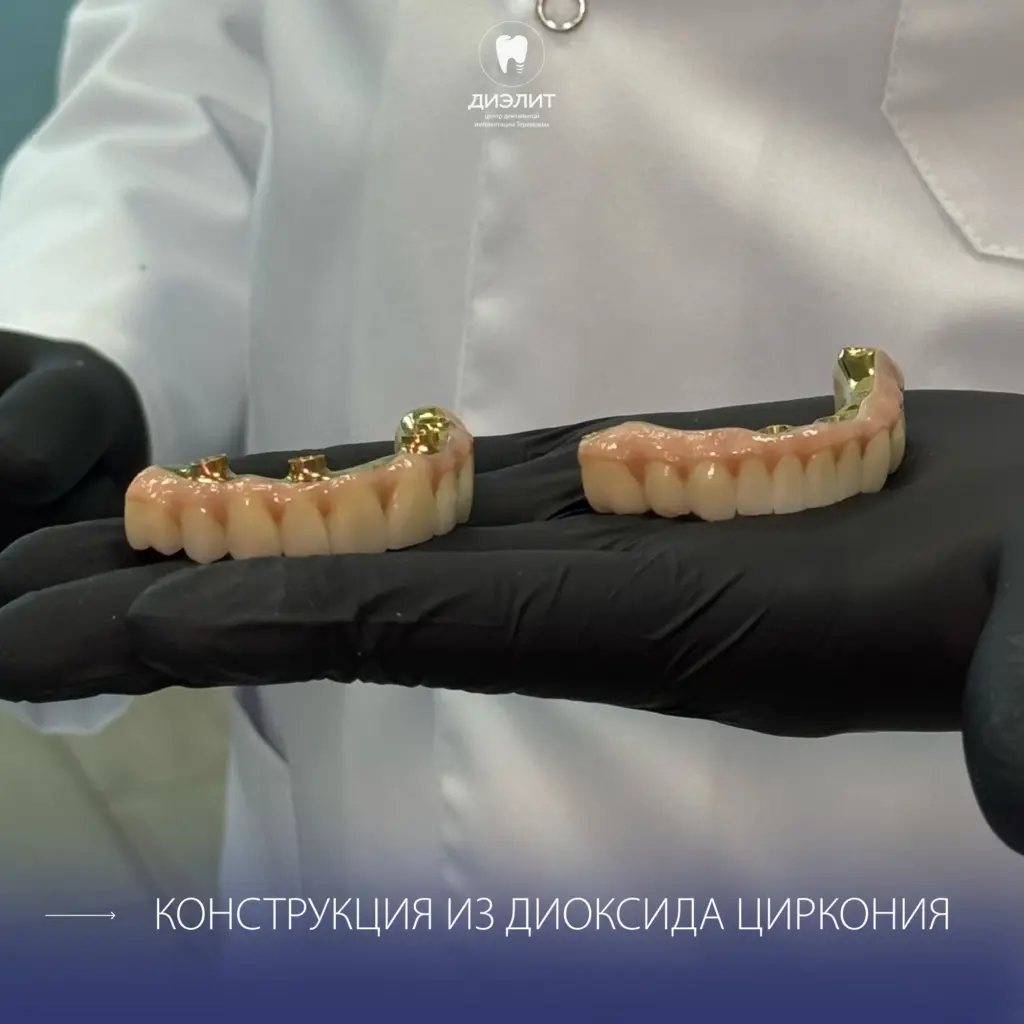 Имплантация верхней и нижней челюсти