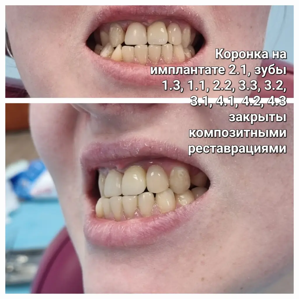 Улыбка с имплантом и художественной реставрацией