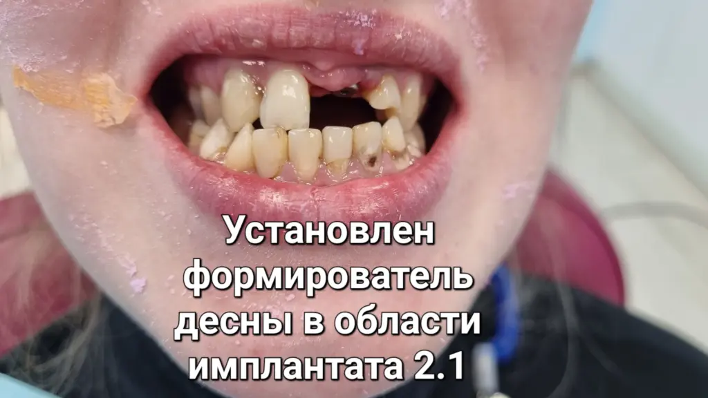 Улыбка с имплантом и художественной реставрацией